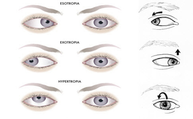 What is nystagmus?Why does it occur? « Contacare Eye Hospital